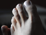 Is Big Toe Joint Pain Ruining Your Life? Discover Quick Relief Now!